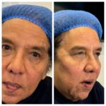 Botox A1