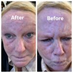 Botox A2