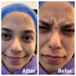 Botox A3