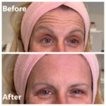 Botox A4