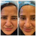 Botox A5