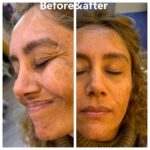 Botox A6