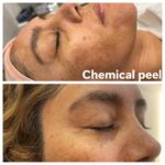 Chemial Peel A1