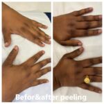 Chemial Peel A2
