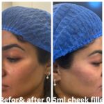 HydraFacial A1